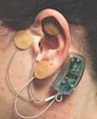 The &ldquo;Bridge&rdquo; device, which has been reported to reduce the pain of drug withdrawal. Provided photo