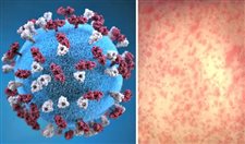 Indiana has first reported case of measles in five years: Here's what to know